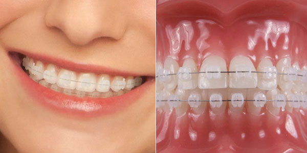 The Pros and Cons of Ceramic Braces - Belmont Smiles