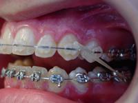 Elastics for Braces – Everything You Need to Know - Stoll