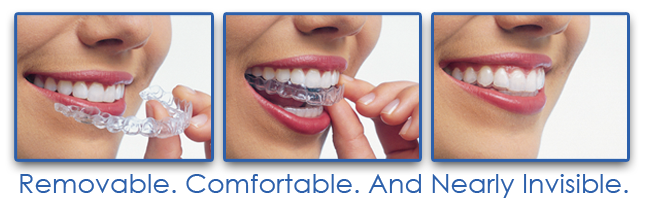 Clarity Ceramic Braces vs Invisalign - Andros Orthodontics, Tri Cities  Orthodontics