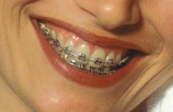 Silver Braces